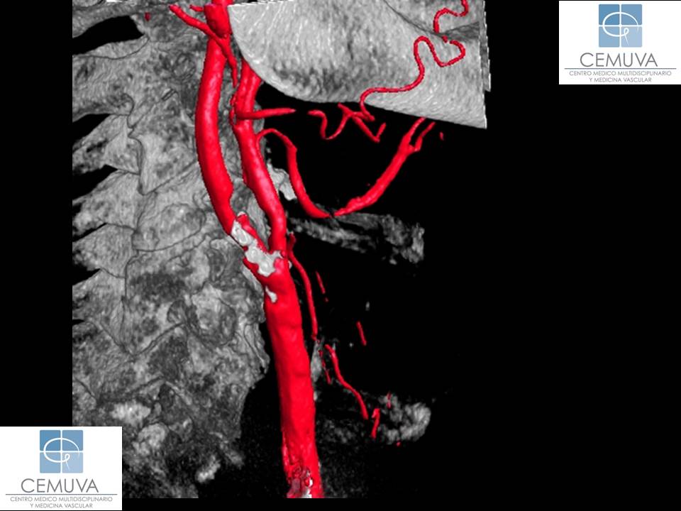 angiografia-3d-de-vasos-del-cuello.jpg