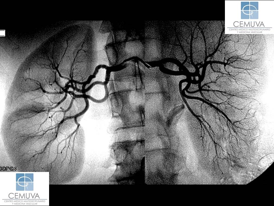 angiografia-renal.jpg